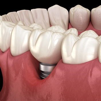 A dental implant in Portland