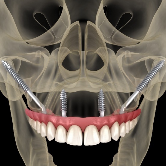 3 D image of smile after the four step dental implant process
